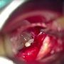 Miringoplastia