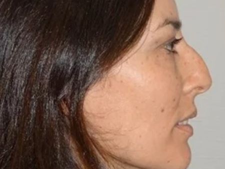 rinoplastia ultrasonica antes despues