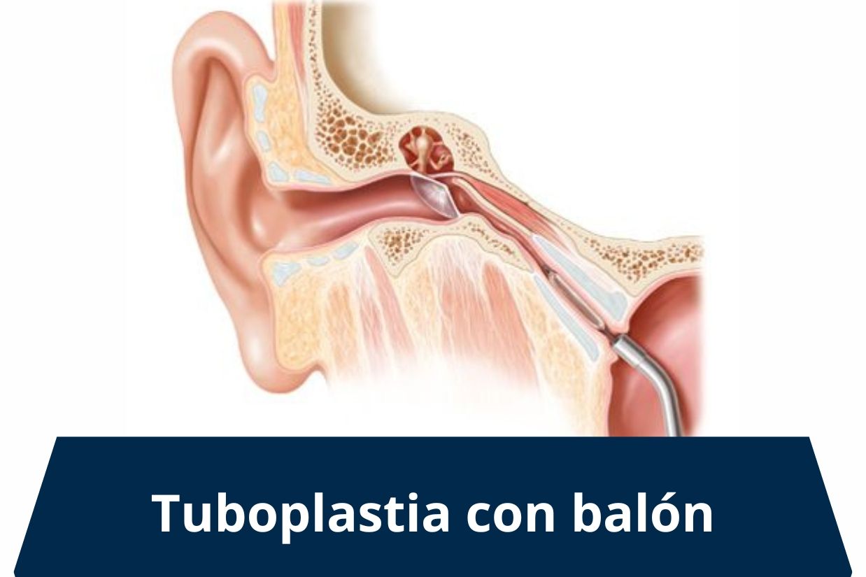 Tuboplastia con balón