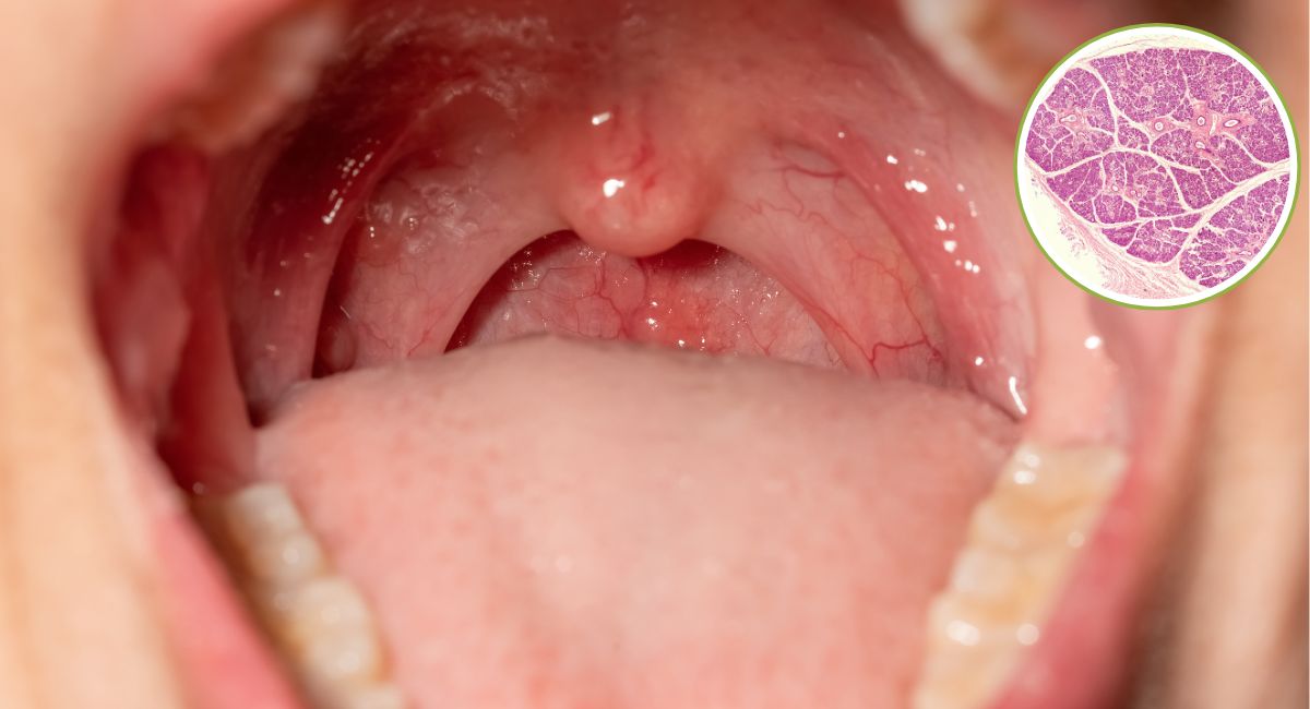 Cirugía glándulas salivales