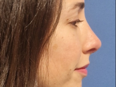 rinoplastia antes después