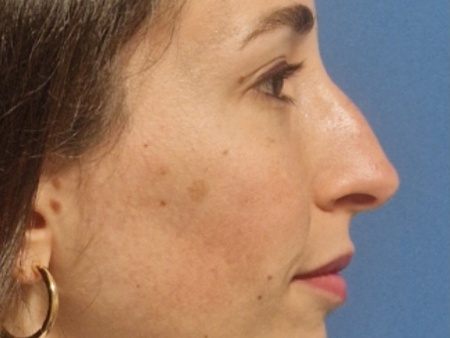 rinoplastia antes después